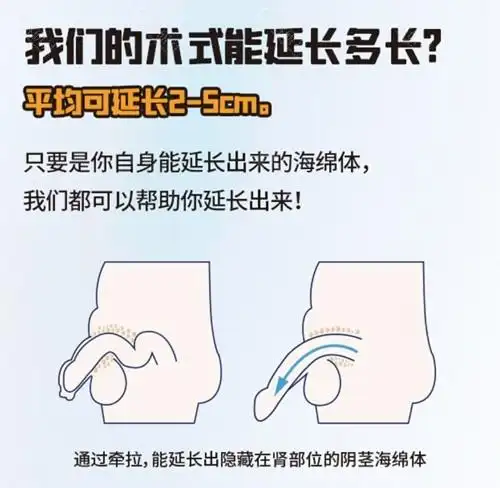 男性生殖器延长手术原理