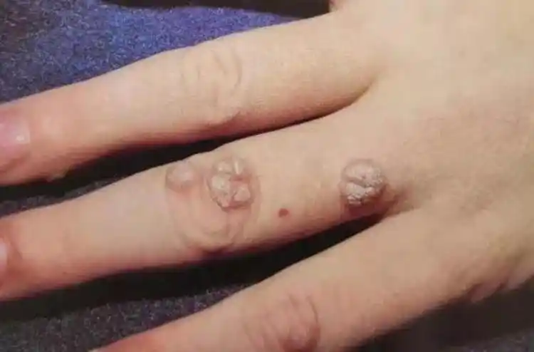 宝宝长了瘊子怎么办谈谈儿童病毒疣