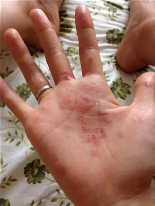 严重的时候手心脚心都会起,超级痒