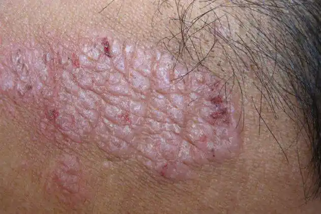 慢性单纯性苔藓慢性单纯性苔藓会导致皮肤表面出现明显性瘙痒感,瘙痒