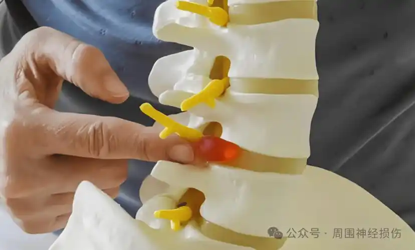 腰椎45膨出腰5骶1突出会压迫哪些神经