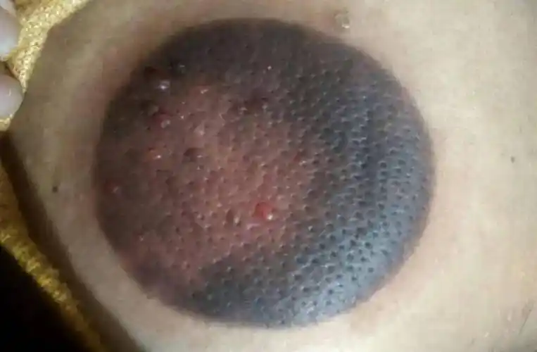 拔罐真的能治病?拔出来黑,紫,青,红各色的罐印都说明什么?