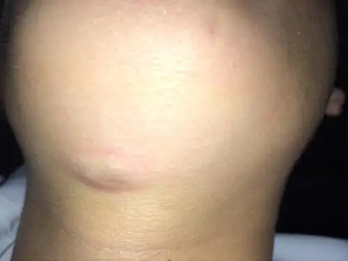 脖子肿了一个大包,咽唾沫吃饭都不疼,怎么办,要不要动手术