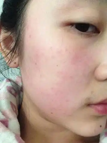 脸部过敏症状_脸部过敏症状的主要表现