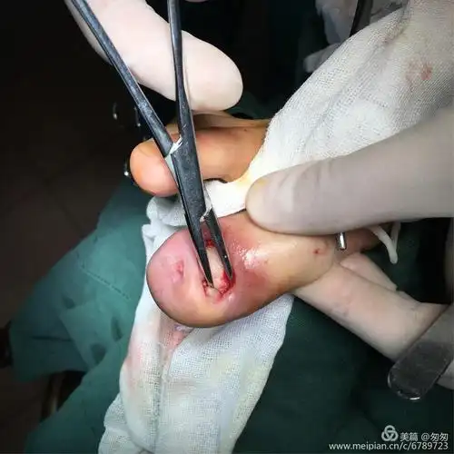 让人痛不欲生的脚趾头