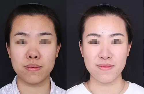 蒜头鼻矫正术_大鼻头缩小_蒜头鼻整形_北京沃尔刘彦军隆鼻整形