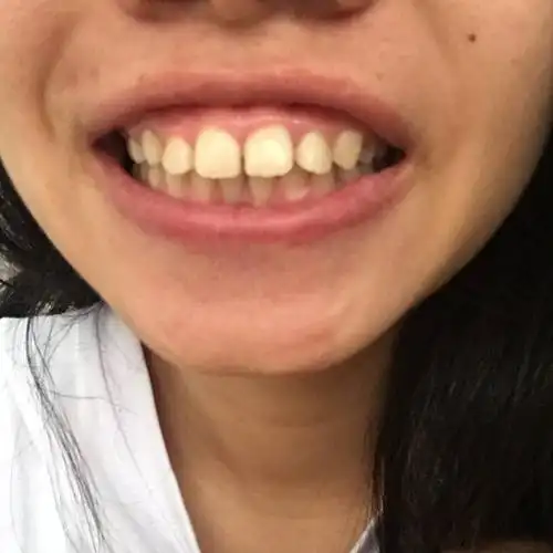 这样骨性和牙性都龅牙,戴牙套效果大不大