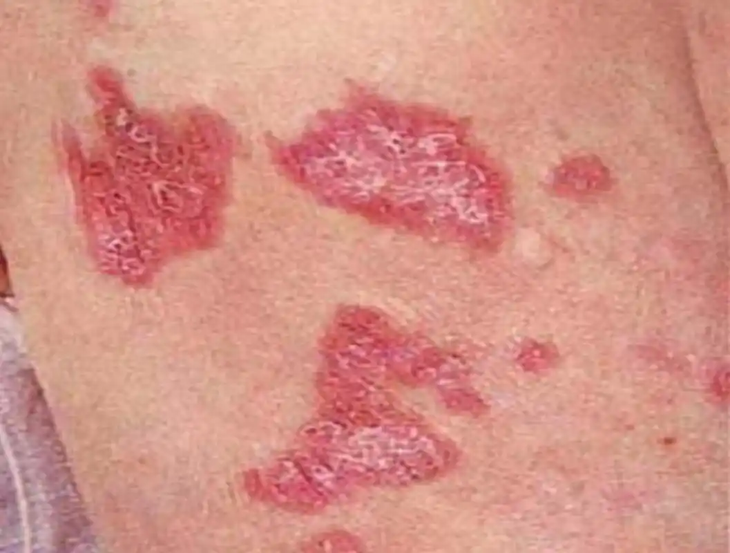 适合大龄!红斑狼疮早期症状真实图片"一往无前"-第1张图片-凝残月网