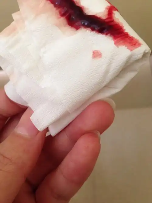 刚上厕所出血了!有照片