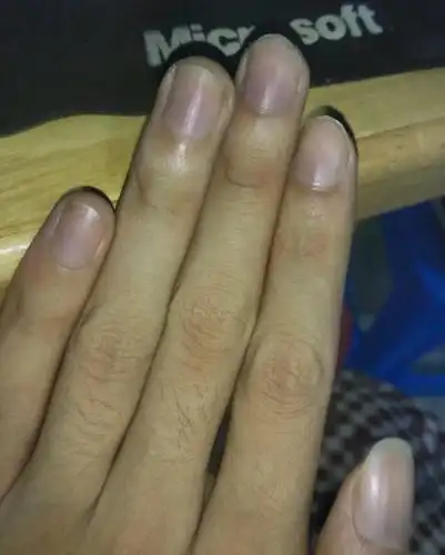 23岁手指甲暗紫怎么搞的,好害怕.平时也有运动什么的.