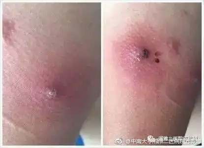 从非洲归来,身上起了几个红坨坨,到中南大学湘雅二医院皮肤科就诊后
