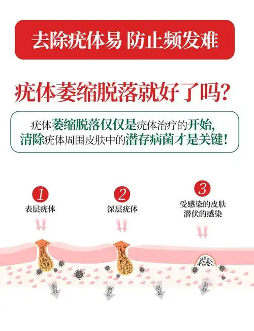 [京选好货]优科利尔 尖锐湿疣湿庞扁平疣去除膏男女肛周鬼臼hs1 一
