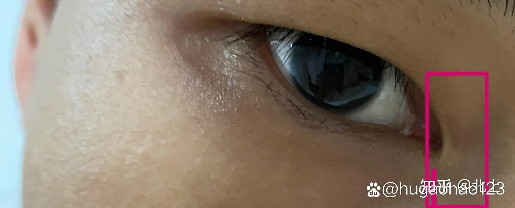 你们谁知道这个内眼角这个白色得是什么嘛