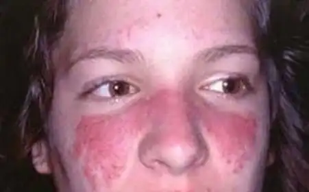 症状都是面部出现鲜红色的斑疹,就像蝴蝶一样,人们就叫这种为蝶形红斑