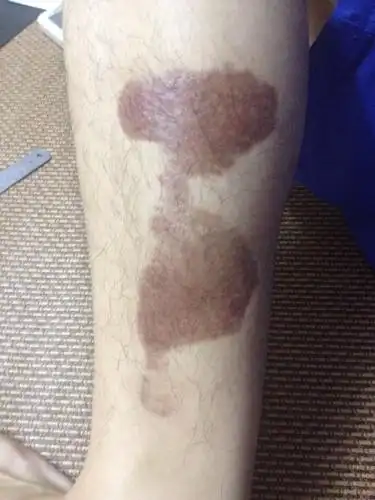 (有图)这伤疤能否用激光祛除?