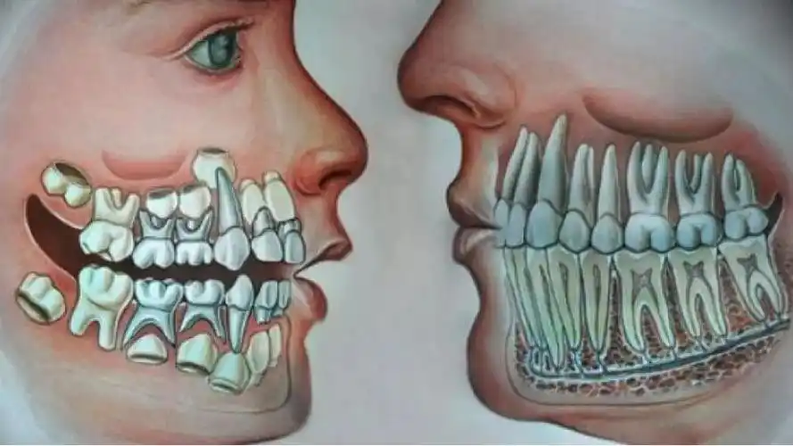 在出生的时候,颌骨中已经包含了两副发育成熟的牙胚:乳牙胚以及恒牙胚