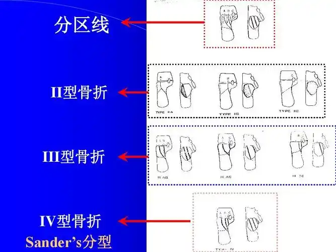 跟骨骨折的治疗方法选择-俞光荣ppt
