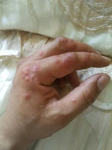 一到夏天,我的手指头就开始长这种东西,挺痒得,哪位大夫帮帮忙给看看