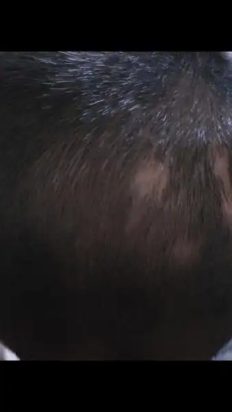 展开全部 这样的情况,应该去医院检查一下,有可能是真菌感染造成的