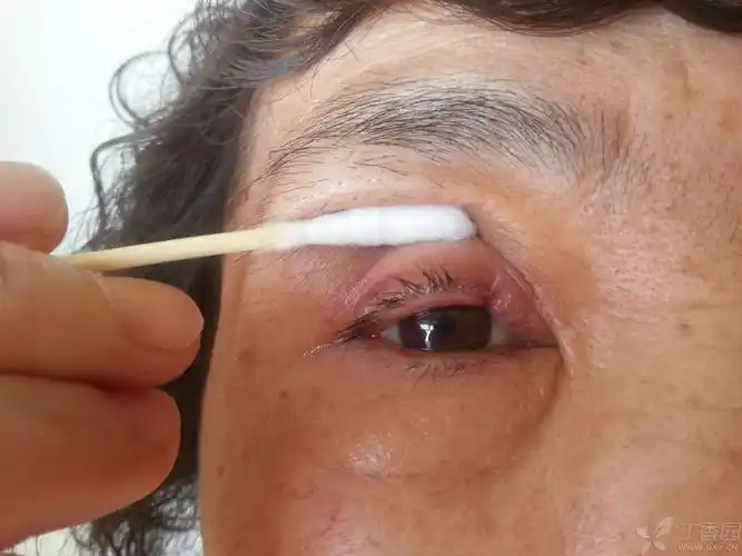 求助女60岁上眼睑肿物切除术后7天病理睑板腺癌求助下一步治疗方案