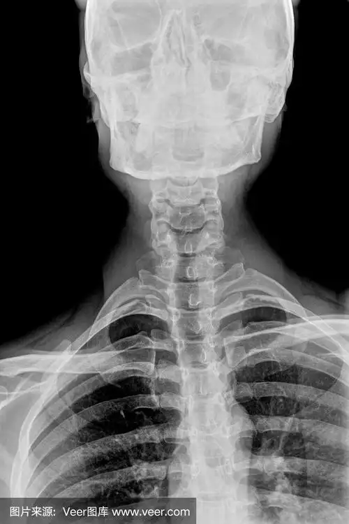 颈椎x线照片