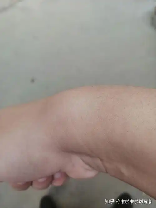 手腕腓骨端有个肿包怎么恢复最近玩腹肌轮