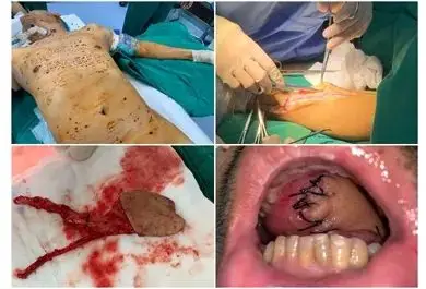 为给他重造因舌癌切掉的13舌头医生从他手臂取下这个