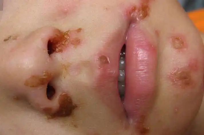 脓疱疮的症状的照片_有来医生