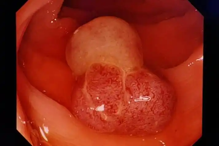 结肠息肉图结肠息肉通常有蒂,呈圆形或卵圆形,肛门指诊可移动,同时