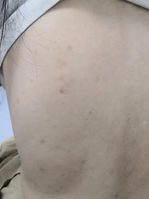 银屑病##解决皮肤问题专注皮肤美容##过敏