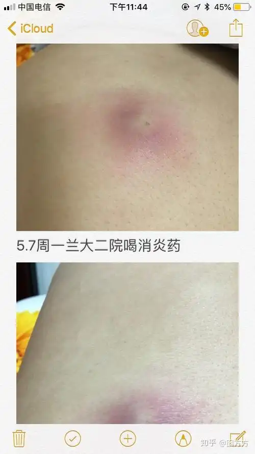 原来我长的不是疖子而是皮脂腺囊肿又称粉瘤