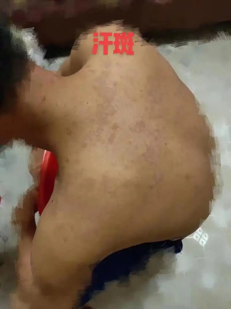 夏天一到汗斑复发好折磨人啊都不敢脱衣服