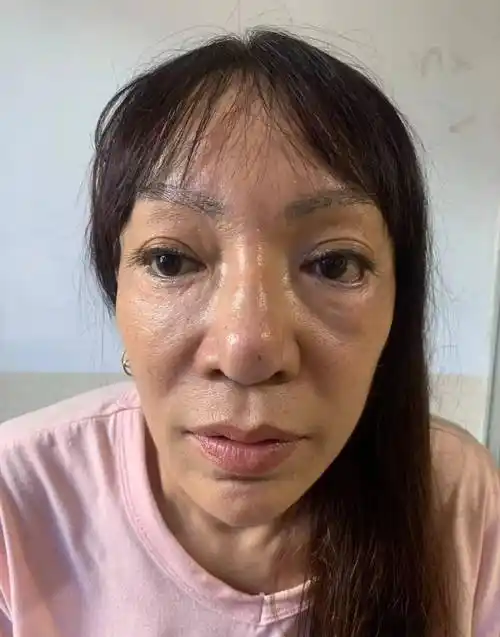 注射的奥美定,骨粉,生长因子,硅油等等,或多或少都会引发不同程度的