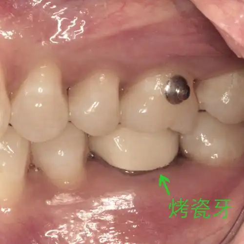 【科普时间】烤瓷牙是否影响牙齿矫正