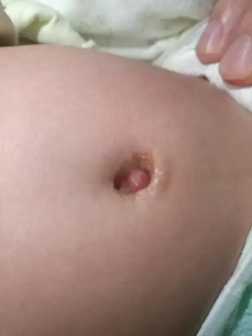 脐茸(脐息肉)脐茸(脐息肉)脐茸,脐息肉,脐窦,脐肠瘘,卵黄管囊肿这几个