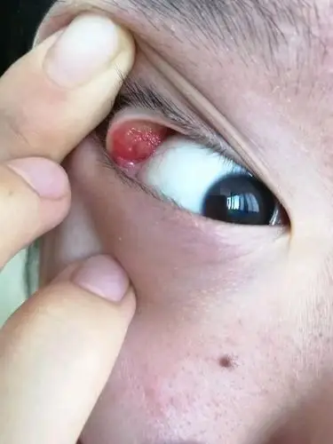 我与霰粒肿的日子