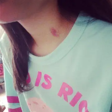 虽然蝌蚪上脑的年轻人喜欢用这种方式在伴侣身上留下印记,但嘬吻痕的