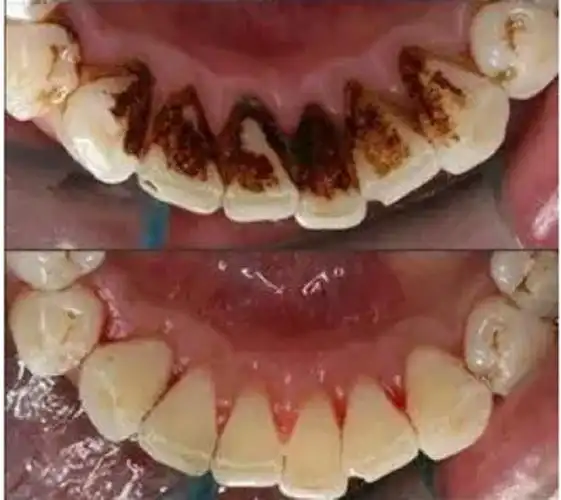 闲暇学会这几招,满嘴牙渍几天就能掉!