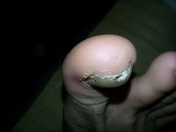 脚趾甲变形变厚,变空,这种趾甲病能治好吗?