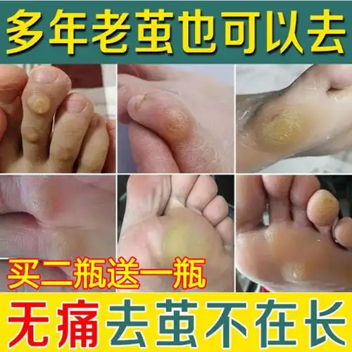 包邮老茧去除脚茧软化剂小脚趾胼胝膏治脚垫的药祛脚底硬死皮神器