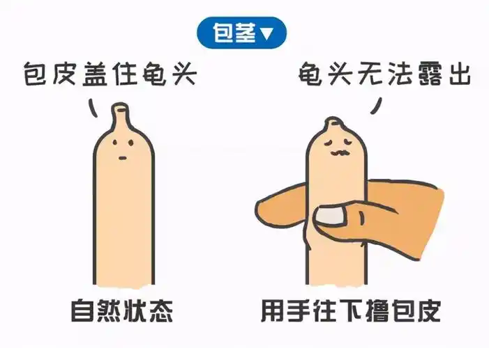 包皮环切术,但是如果是包茎的话就还是强烈建议来医院进行包皮环切