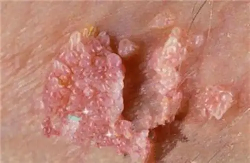 女性假尖锐湿疣图片