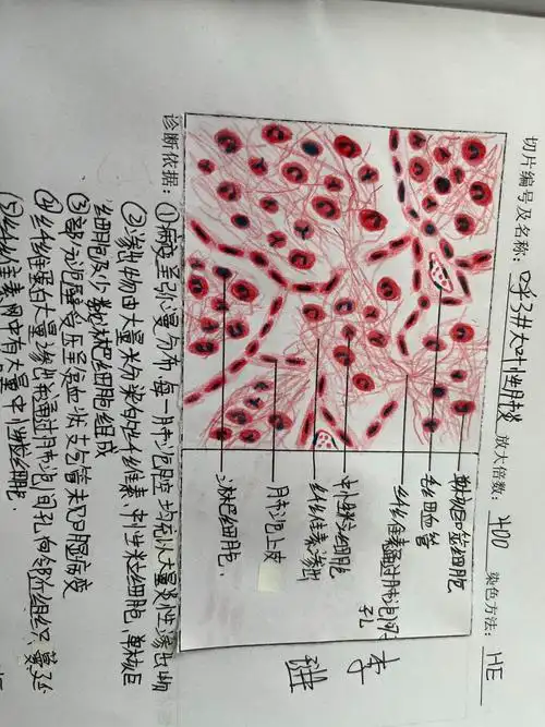 大叶性肺炎手绘图硅肺手绘图
