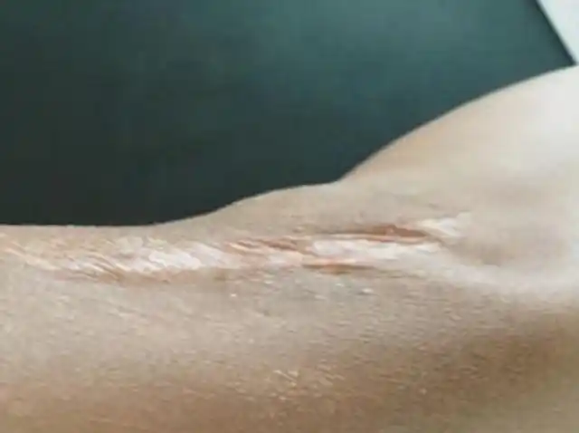 萎缩性瘢痕的患者,多因灼伤导致,对皮肤外观影响大,及时就医