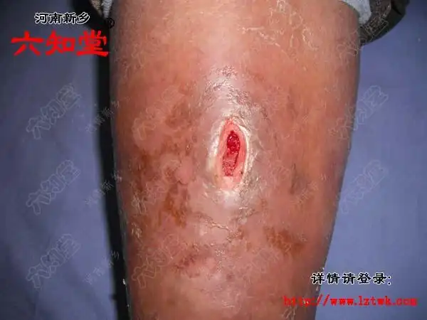 碰伤引发小腿丹毒的治疗病例 - 韩氏膏药治疗褥疮 糖尿病足病 伤口不