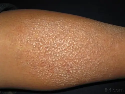 看图识病皮肤淀粉样变