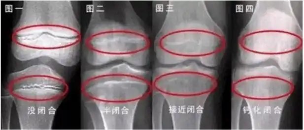 13岁男孩160cm骨骺线快要闭合是怎样造成的怎样补救