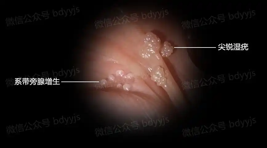 男性真假尖锐湿疣图片