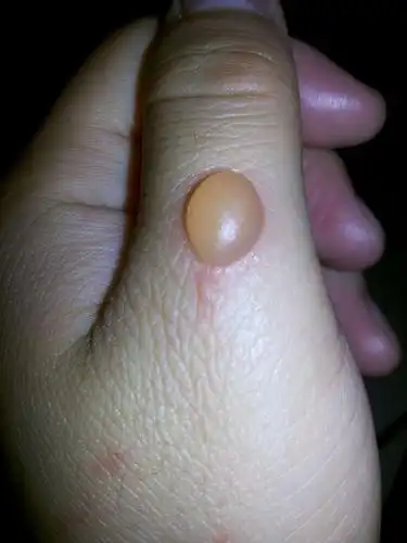 手指背 水泡 会变大