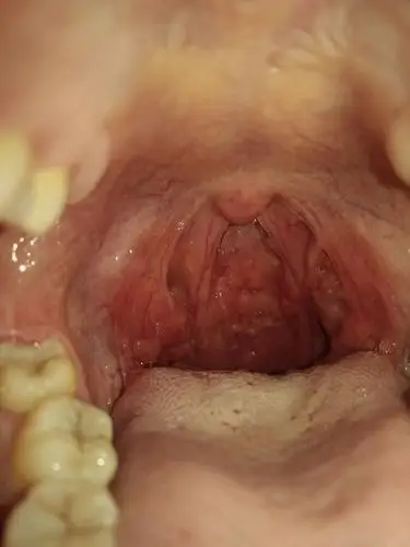 咽喉炎,咽后壁都是滤泡,然后还有扁桃体一度肿大,我该怎么办!急急急!